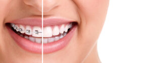 orthodontic treatment